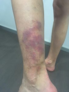 Insuficienta venoasa cronica: Cauzele frecvente ale edemului picioarelor