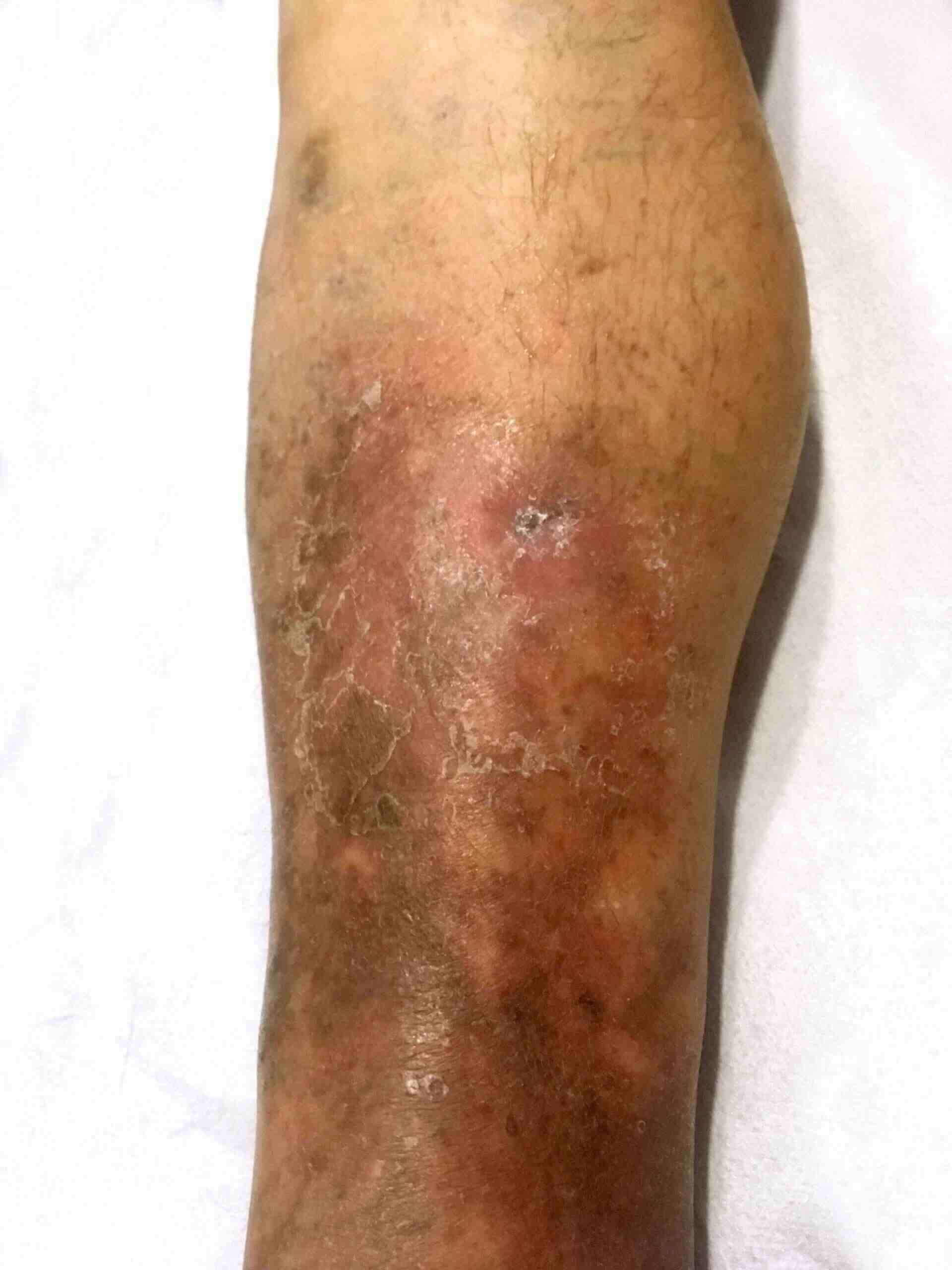 Tratament pentru eczema varicoasă, Eczema pe picioare în tratamentul venelor varicoase